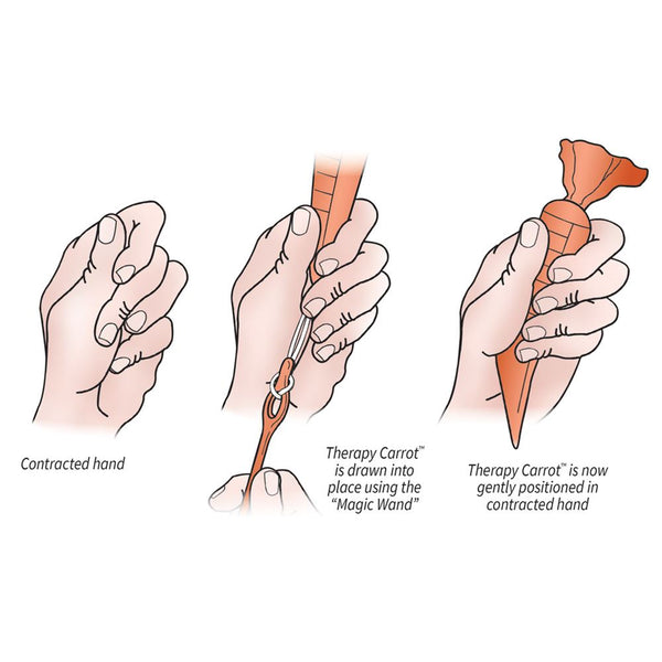 AliMed Original Therapy Carrot Hand Contracture Orthosis Kit Original Carrot Kit: Large, Green - 51025